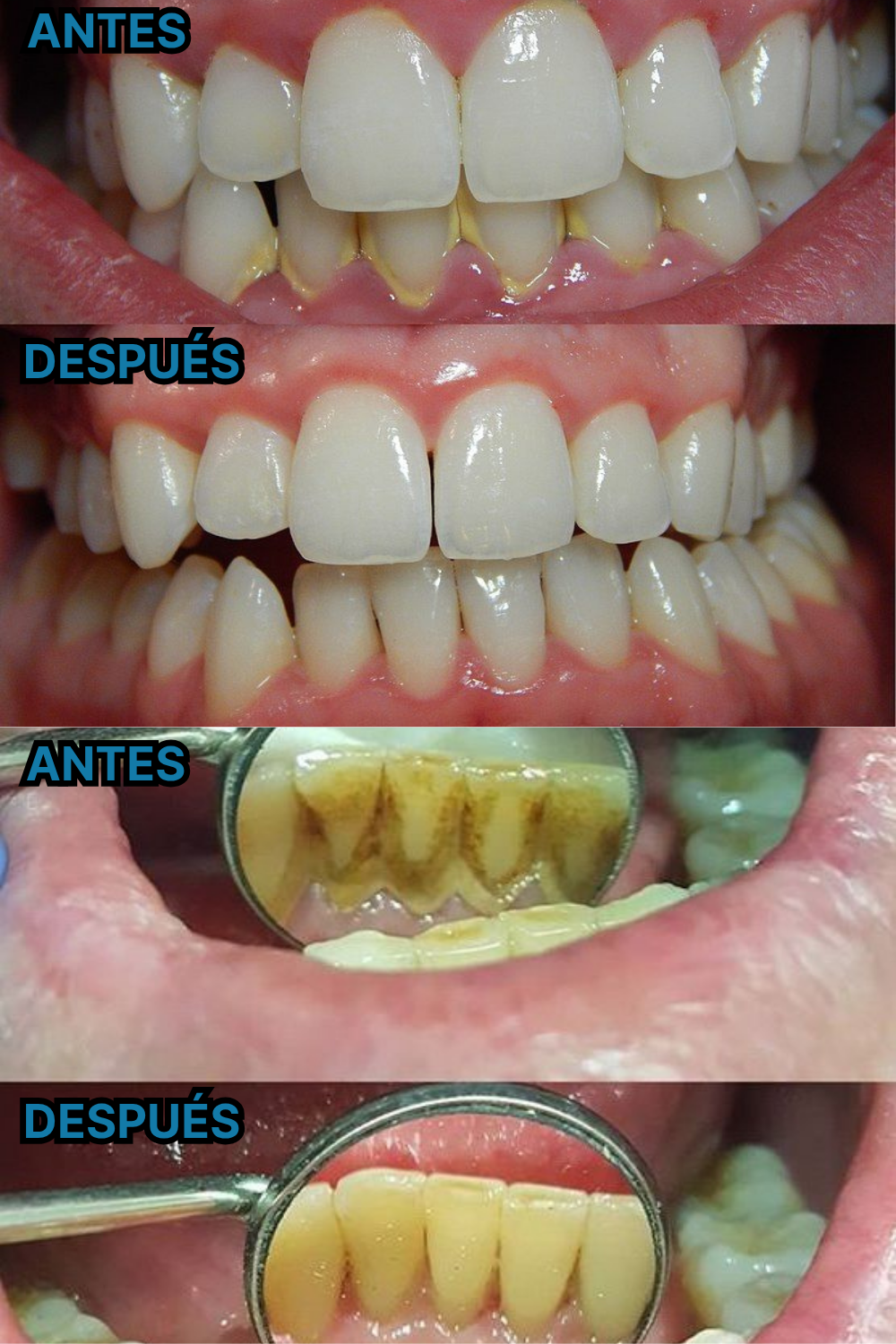 HYDRO PULSE (DUCHA DENTAL) + CEPILLO ULTRASÓNICO (6 MODOS) INTELIGENTE DE REGALO 🎁